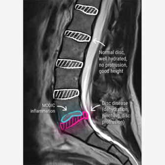 Degenerative Disc Disease - CCV Montpellier