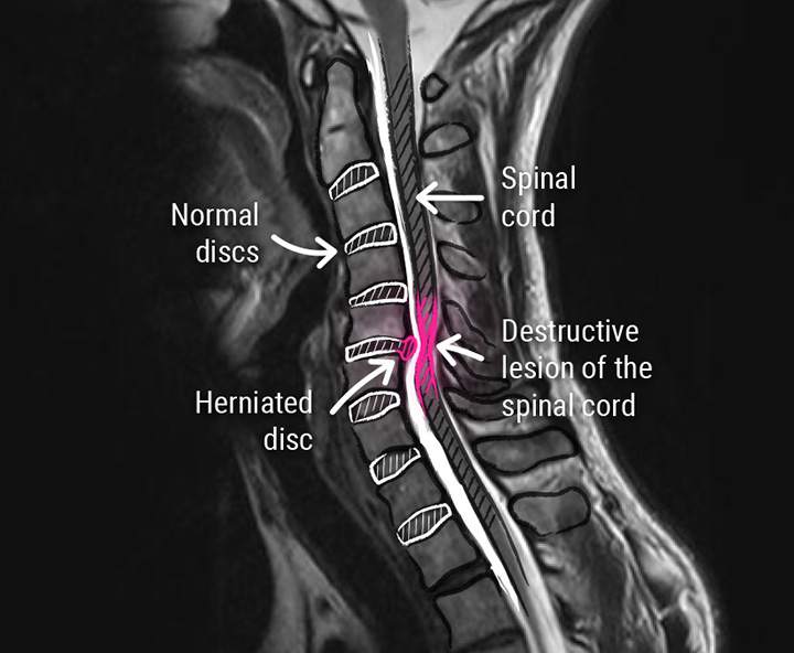 Herniated Cervical Disc